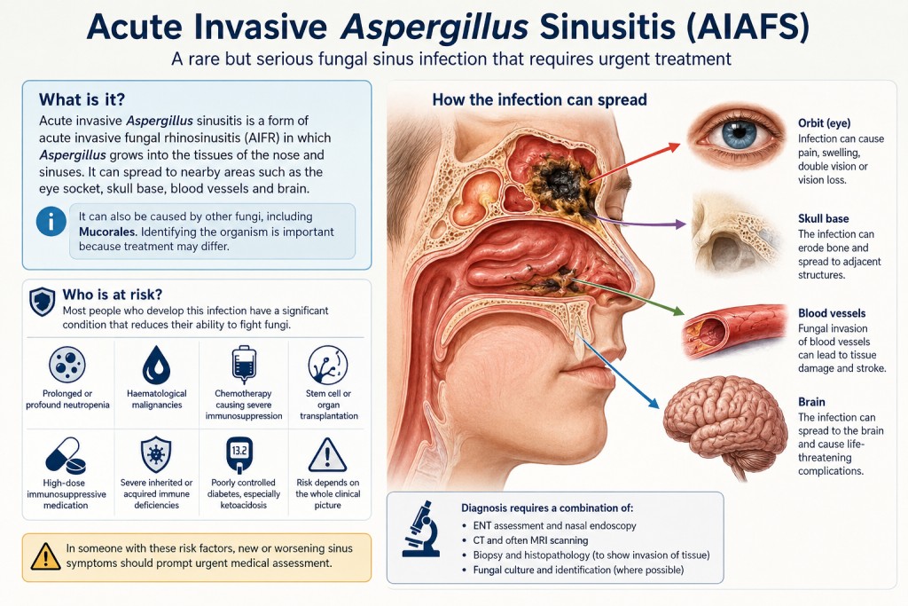 Medical illustration showing acute invasive Aspergillus sinusitis and possible spread from the sinuses to the eye, blood vessels and brain.