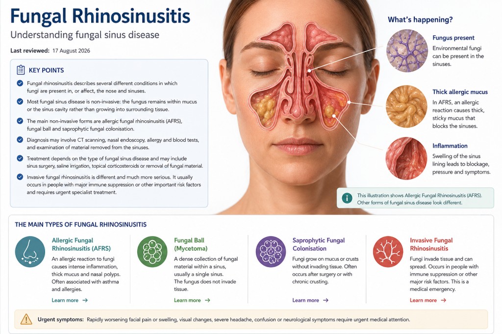 Medical illustration of fungal rhinosinusitis showing inflamed sinuses and the main types including AFRS, fungal ball, fungal colonisation and invasive disease.